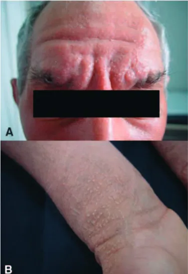 Figure 1. Firm, waxy, closely spaced papules particularly  visible in the forehead A), but also in the forearms B).
