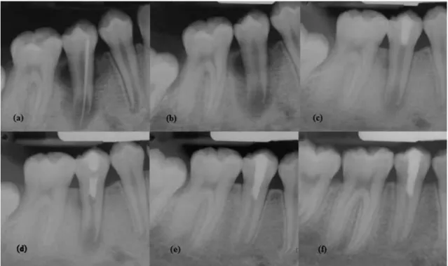 Figura 10  –  Caso clínico de revascularização de um pré-molar inferior imaturo com periodontite   apical e fístula utilizando como medicação intracanalar PTA 