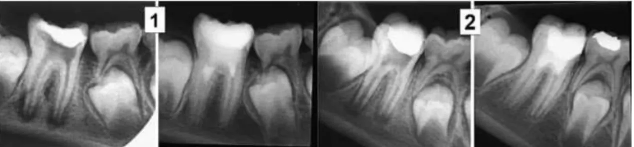 Figura 11  –  Casos clínicos de revascularização de molares com ápex imaturo e periodontite apical  utilizando como medicação intracanalar HC 