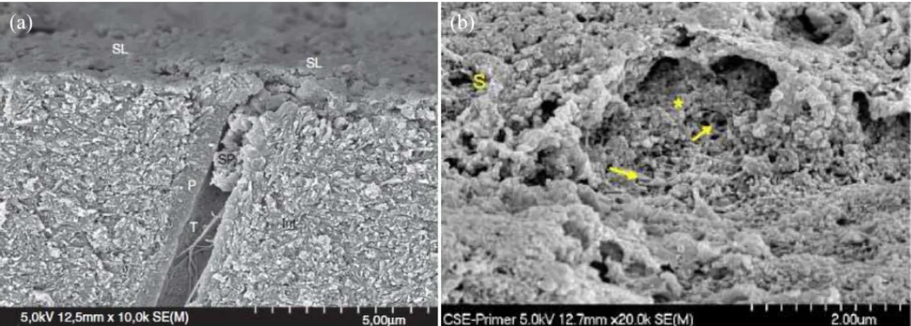 Figura 5  – (a) Smear layer e smear plugs dentinários (SEM). (Sezinando, 2014). (b) Espessura da smear  layer  que  cobre  a  dentina  após  a  utilização  de  um  self-etching  primer  (SEM)