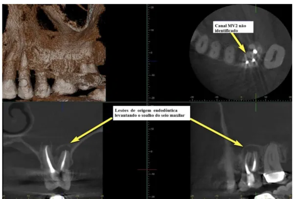 Figura 9: Lesões de origem endodôntica e canal MV2 não tratado  Adaptado de McClammy (2014)