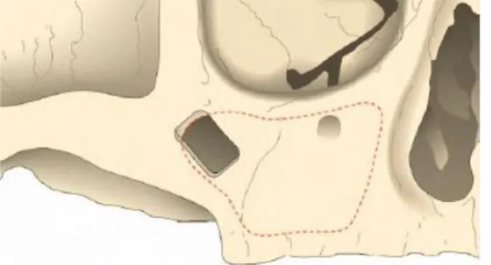Figura 8. Posicionamento da janela óssea  na parede anterior da maxila (Branemark,  2004) 