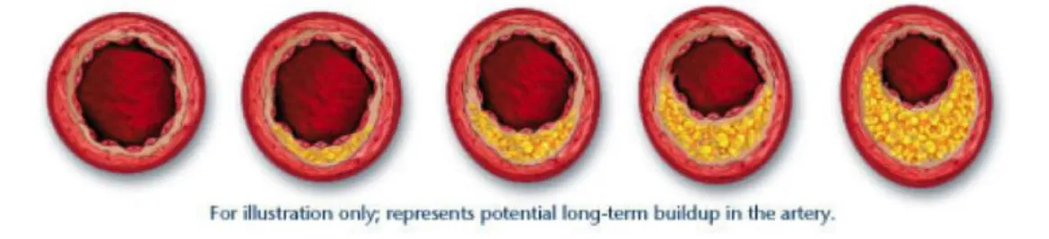 Figura 2: Representa o acúmulo de gordura, a longo prazo, na artéria  (http://www.leforte.com.br/?c=1651)