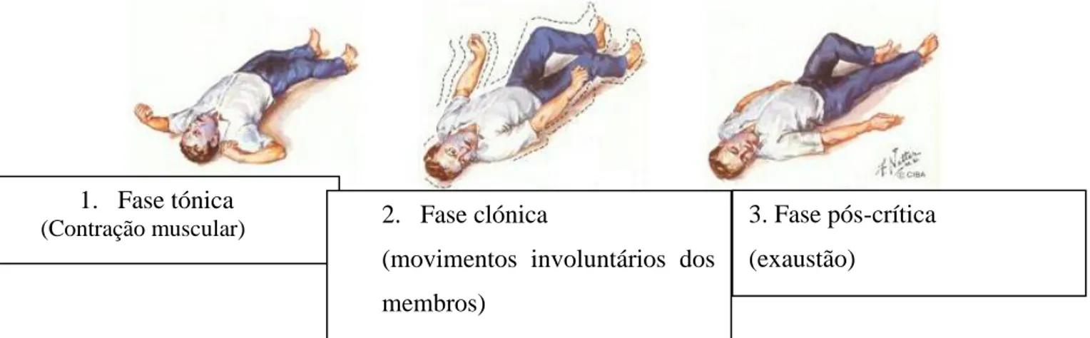 Figura 4: Convulsões tónico-clónicas (Escéptica 