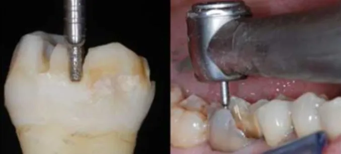 Figura 2 - Realização dos sulcos de guia sobre um dente isolado e in vitro (Adaptado de Fages  e Bennasar, 2013)