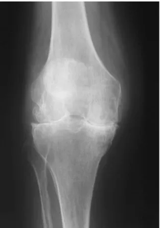 Figura nº 5- Articulação do joelho com perda da cartilagem articular. Adaptado de Hughes, 2008