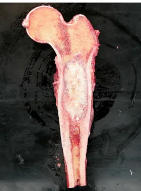 Figura nº 8- Osteosarcoma no fémur. Adaptado de MacDuff e Reid, 2008. 