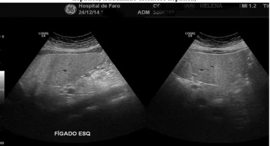 Figura 2.8  –  Imagem de esteatose em fígado aumentado porta de 14 mm traduzindo  DHC