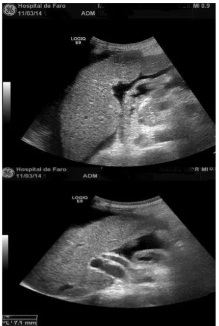 Figura 2.16 - Imagens: imagens de fígado transversal e longitudinal. Escassez de veias  hepáticas periféricas, Fígado com menores dimensões, Ausência de linha capsular fina 