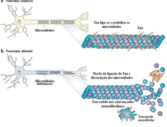 Figura 5- Formação de entrançados neurofibrilhares a partir da proteína tau e a consequente destabilização  dos microtúbulos