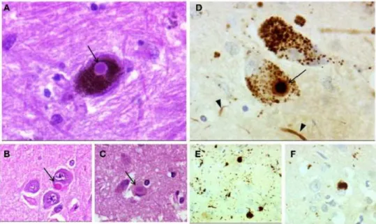 Figura 6- Neuropatologia da doença de Parkinson. (A) Corpo de Lewy (seta) num neurónio da SNpc,  no  hipocampo (B),  e  no  córtex  (C) –  coloração  hematoxilina-eosina  400x