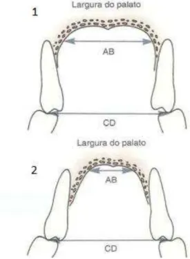Figura 5- 1: Mordida Cruzada Posterior Dentária  –  dentes inclinados para dentro e largura apropriada do  palato  (distância  AB=  CD);  2:  Mordida  Cruzada  Posterior  Esquelética  –   largura  inadequada  do  palato  (distância AB &lt;CD) (Adaptado de: