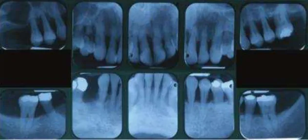 Fig. 3 - Conjunto de radiografias periapicais de um paciente com 55 anos de idade, que mostra  a perda horizontal óssea avançada (Baker &amp; Needleman, 2010) 