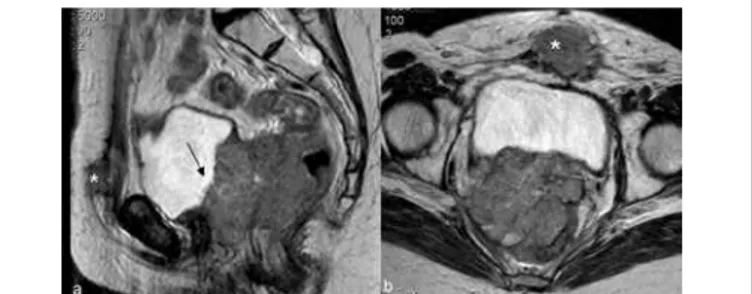 Figure 12: Central recurrence of uterine cervical carcinoma after hysterectomy  for uterine cervical carcinoma FIGO IB1