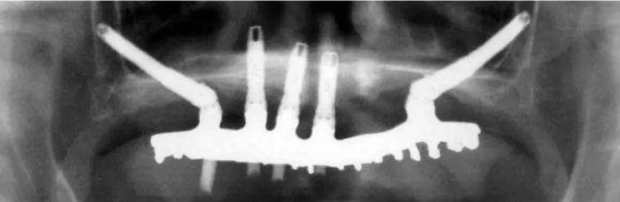 Figura 2. Colocação de dois IZ associados a implantes convencionais na zona anterior da maxila