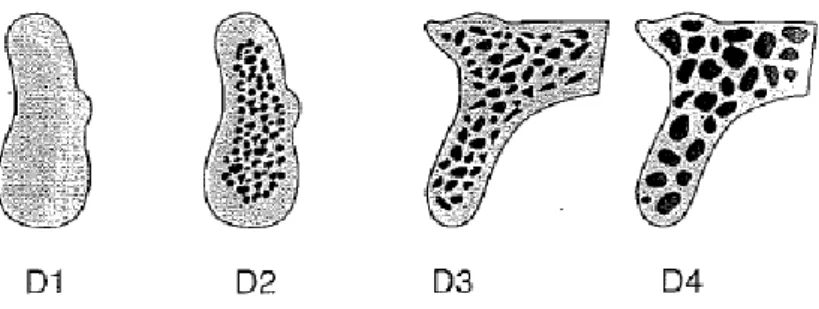 Figura  3- Classificação de Misch (1988). D1 – Presença de osso cortical denso; D2 – Osso cortical  poroso  denso  e  osso  trabecular  denso;  D3-  Osso  cortical  poroso  e  fino  e  osso  trabecular  fino;  D4  –  Quase não existe osso cortical e o osso