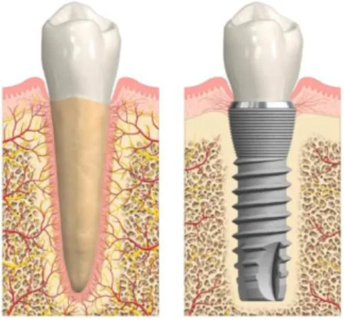 Figura  4-  Diferença  entre  um  dente  natural  (primeira  imagem)  e  um  implante  dentário  (segunda  imagem) (Albrektsson, et al, 2013)