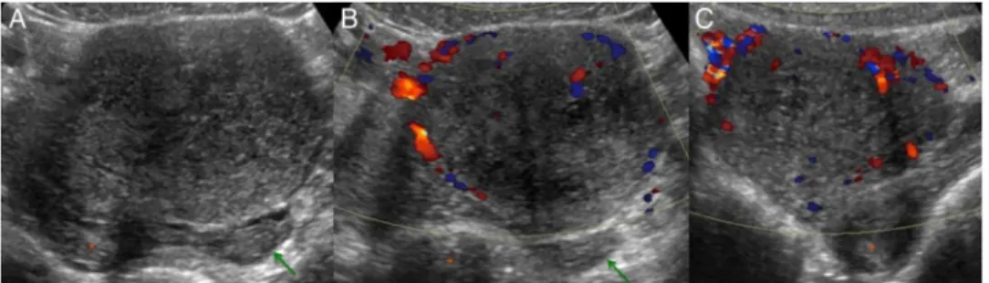 Figure 1 (A) Transabdominal ultrasound shows a solid hypoechoic tumour with regular borders, measuring 78×55×70 mm (159 cc), in the dependence of the right ovary