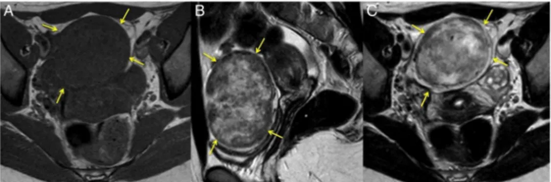 Figure 2 MRIs revealed an ovoid solid tumour associated with the right ovary, with regular contours, measuring 8 cm of major axis