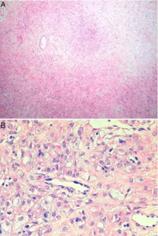 Figure 4 On diffusion study, the lesion showed hypointensity on high b values ( b =1000) (A), and hyperintensity on ADC map (B),