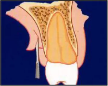 Figura  13:  Disseção  de  espessura  parcial,  paralela  ao  eixo  longitudinal  dos  dentes, realizada  dentro  da  incisão