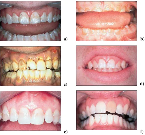 Figura 3. Pigmentação intrínseca a) Amelogénese imperfeita b) Dentinógenese imperfeita  c) Flúorose dentária d) Hipoplasia de esmalte e) Pigmentação por tetraciclinas f) Trauma 