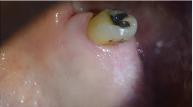 Figura 10 : Fotografia intra-oral vista oclusal do 28 