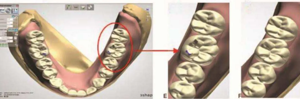 Figura 2 - Deteção e eliminação de pontos de interferência durante a elaboração de próteses  totais através da tecnologia CAD/CAM.