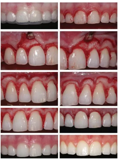 Figura 4- Reposicionamento apical do retalho com osteotomia 