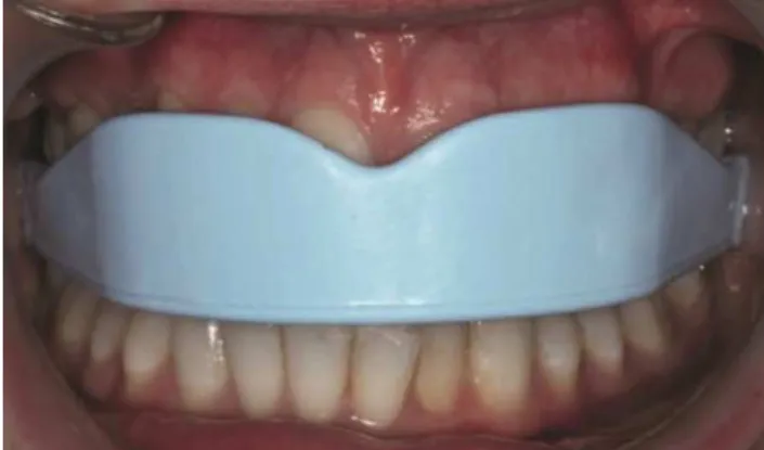 Fig. 2: Protetor bucal pré-fabricado, maxilar simples em boca (adaptado de Parker et al., 2017)