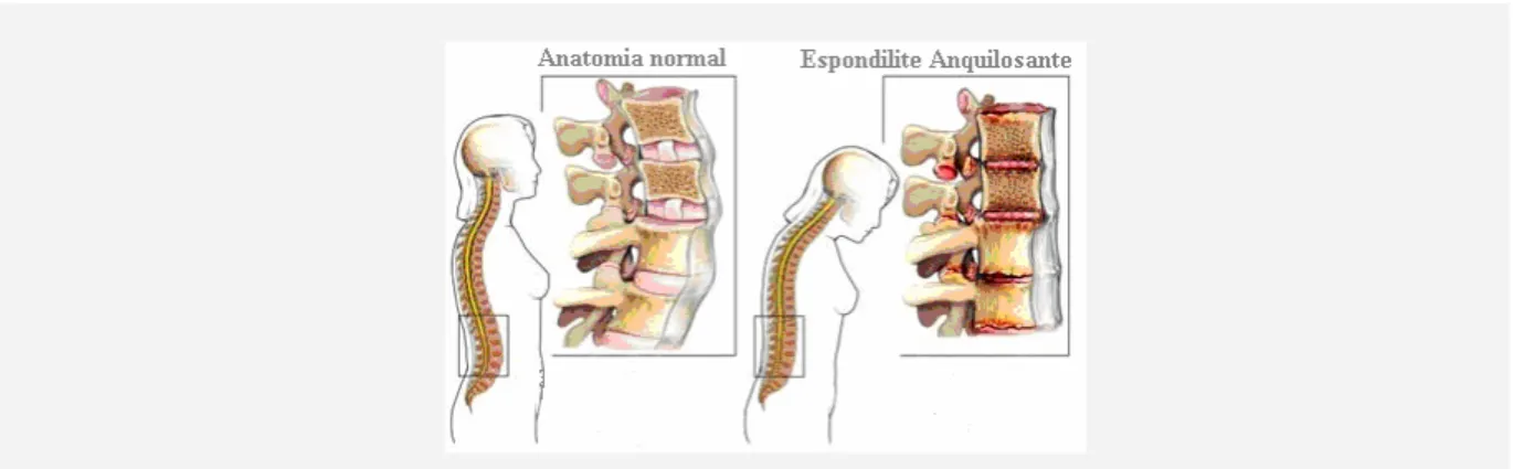 Figura 1- Representação da coluna vertebral normal e patológica 