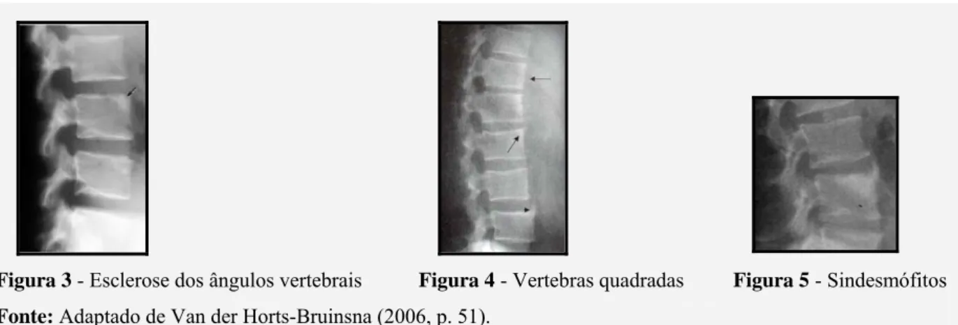 Figura 3 - Esclerose dos ângulos vertebrais  Figura 4 - Vertebras quadradas  Figura 5 - Sindesmófitos Fonte: Adaptado de Van der Horts-Bruinsna (2006, p