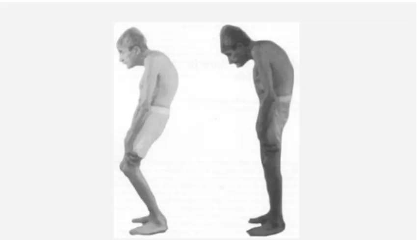 Figura 9 – Postura do paciente com Espondilite Anquilosante  Fonte: Adaptado de Roussouly et al