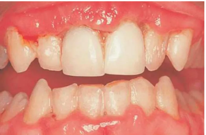 Figura 9 - Imagem de cavidade oral de paciente com o estado de doença Gengivite Ulcerativa Necrosante  Aguda