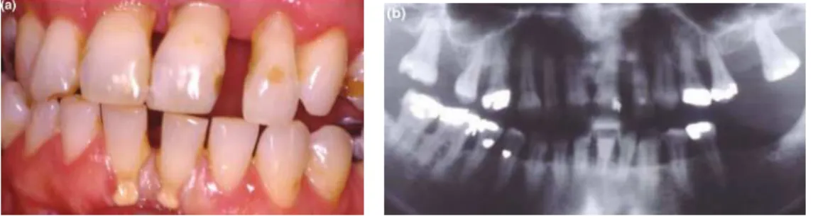Figura 10 - Fotografia de paciente com periodontite crónica (a) e radiografia ortopantomografia do mes- mes-mo  paciente  (b)