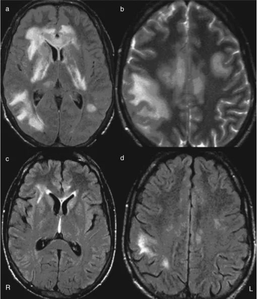 Figure 1: (a, b)brain magnetic resonance images (MRIs) performed on day 6. Axial  fluid-attenuated inversion recovery (FLAIR) and axial T2–TSE show bilateral asymmetric confluent hyperintensity involving subcortical white matter, corpus callosum, and deep 