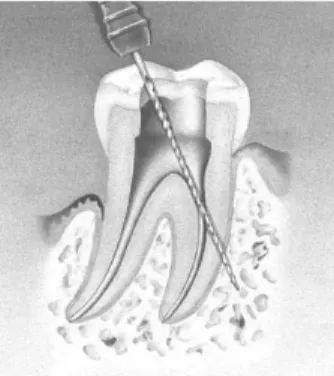 Figura 1. Perfuração num molar (in Fuss et Trope - 1996)