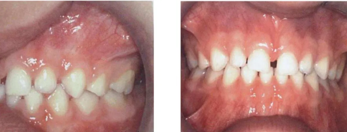 Figura 1. Etapa da dentição decídua. (Toledo, 2012) 