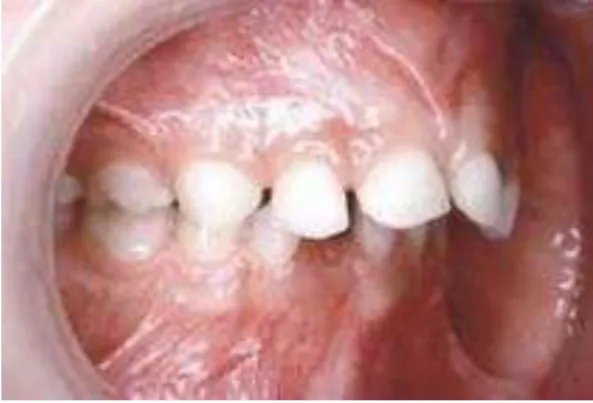 Figura 8. Sobressaliência aumentada em fase de dentição decídua. (Earl Bergensen,  http://www.orthodonticproductsonline.com/2013/09/eruption-guidance/) 