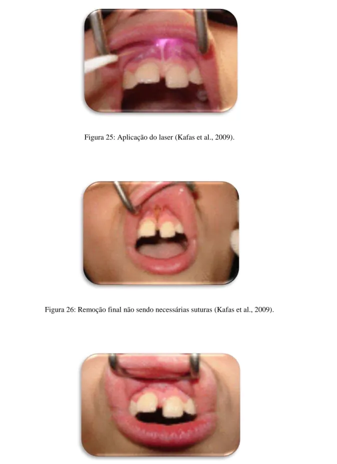 Figura 26: Remoção final não sendo necessárias suturas (Kafas et al., 2009). 