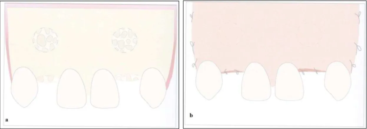 Figura 3-  Alguns passos ilustrativos da “ Técnica de Peñarrocha ”  (a  –  osso utilizado no enxerto é obtido a  partir da região vestibular adjacente utilizando uma broca de trefina; b  –  retalho trapezoidal de espessura 