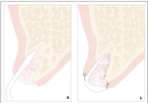 Figura 4 -  Alguns passos ilustrativos da “Técnica de Elian” (a –  utilizada uma membrana de colagéneo e  enxerto ósseo alógeno liofilizado mineralizado; b  –  sutura reabsorvível 5/0 usada para suturar a 