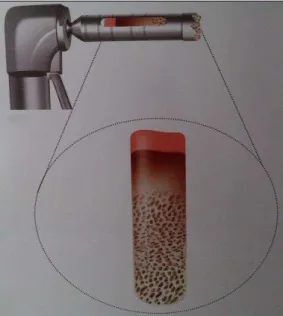 Figura 5 - Representação de uma broca trefina com recolha de enxerto, compatível com as suas  dimensões (Joly et al, 2010)