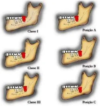 Figura 1-  Classificação de Pell &amp; Gregory adaptada da Revista de Cirurgia e Traumatologia Buco- Buco-Maxilo-Facial 