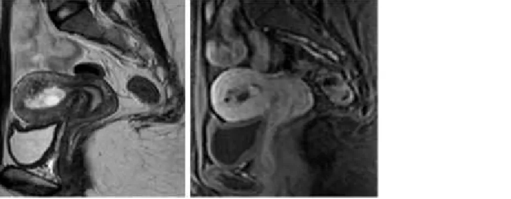 Figure 5 Para-sagittal T2WI (A) and fat-suppressed postcontrast T1WI (B)