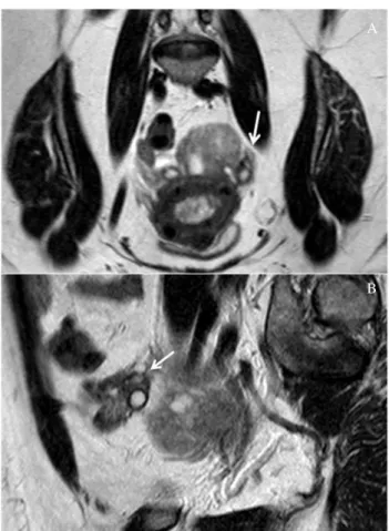 Fig. 6 - Axial T1-weighted magnetic resonance. The mass demonstrates isosignal with adjacent muscle on T1-weighted sequence.