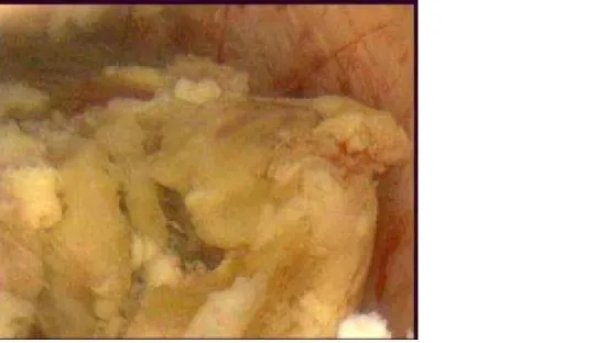 Figure 4 Histology of the biopsies done during hysteroscopy