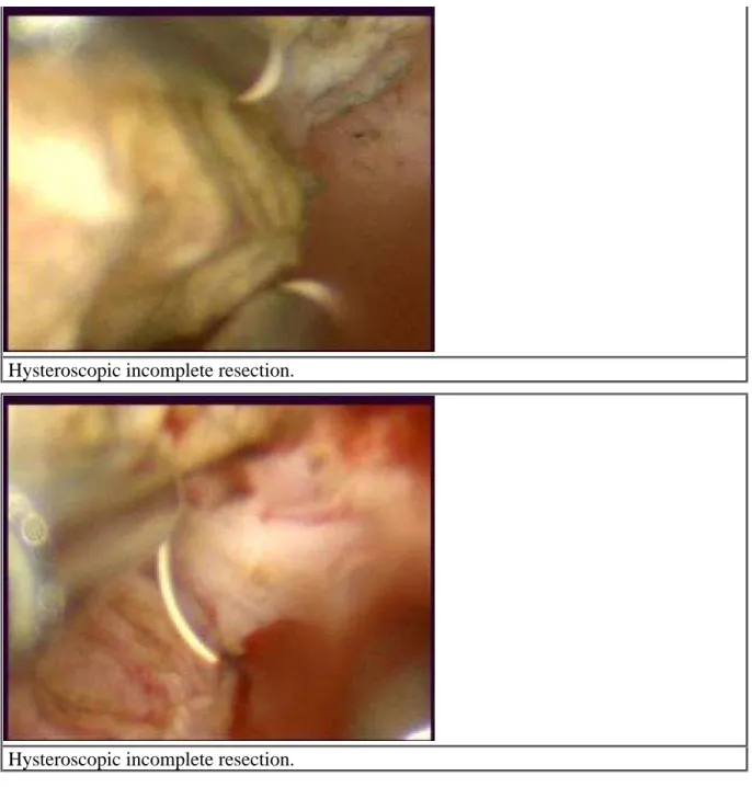 Figure 7 Surgical specimen of hysterectomy