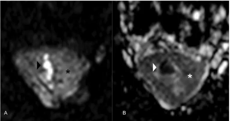 Figure 4: Specimen obtained from the uterus of a 34-year-old female patient with placental site trophoblastic tumor