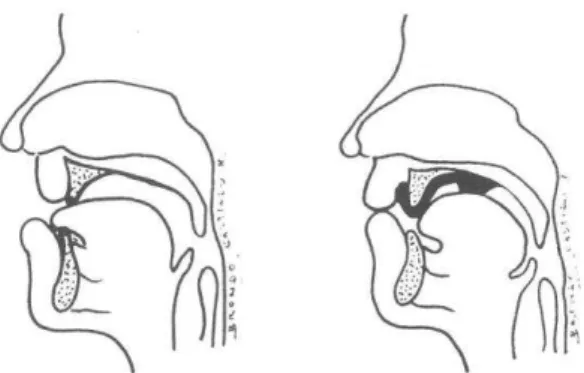 Figura 5  –  Corte Sagital da cavidade oral de bebé com Síndrome de Down Com e Sem Placa Palatina de  Castillo-Morales (www.castillomoralesvereinigung.de) 